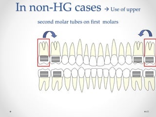 In non-HG cases  Use of upper
second molar tubes on first molars
41
 
