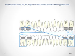 second molar tubes for the upper first and second molars of the opposite side.
42
 
