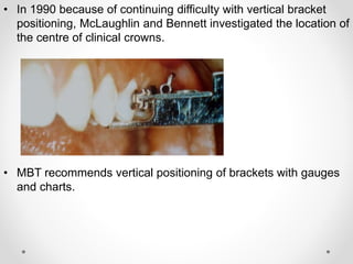 • In 1990 because of continuing difficulty with vertical bracket
positioning, McLaughlin and Bennett investigated the location of
the centre of clinical crowns.
• MBT recommends vertical positioning of brackets with gauges
and charts.
 