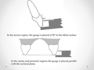 In the incisor region, the gauge is placed at 90° to the labial surface
In the canine and premolar regions the gauge is placed parallel
with the occlusal plane.
 