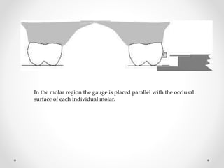 In the molar region the gauge is placed parallel with the occlusal
surface of each individual molar.
 