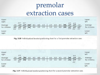 premolar
extraction cases
 