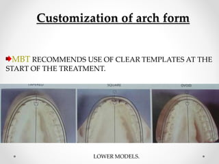 Customization of arch form
MBT RECOMMENDS USE OF CLEAR TEMPLATES AT THE
START OF THE TREATMENT.
LOWER MODELS.
 