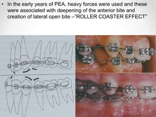 • In the early years of PEA, heavy forces were used and these
were associated with deepening of the anterior bite and
creation of lateral open bite –”ROLLER COASTER EFFECT”
 