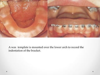 A wax template is mounted over the lower arch to record the
indentation of the bracket.
 
