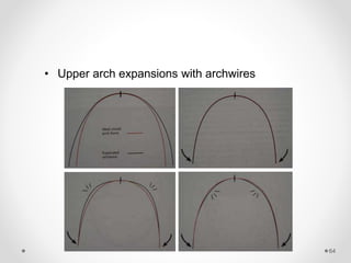64
• Upper arch expansions with archwires
 