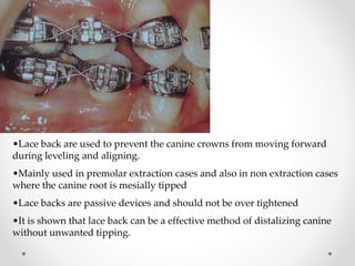 •Lace back are used to prevent the canine crowns from moving forward
during leveling and aligning.
•Mainly used in premolar extraction cases and also in non extraction cases
where the canine root is mesially tipped
•Lace backs are passive devices and should not be over tightened
•It is shown that lace back can be a effective method of distalizing canine
without unwanted tipping.
 