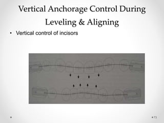 73
Vertical Anchorage Control During
Leveling & Aligning
• Vertical control of incisors
 