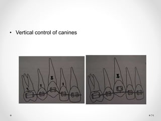 74
• Vertical control of canines
 