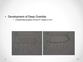 77
• Development of Deep Overbite
• Unrestricted eruption of low 2nd molars in cl II
 
