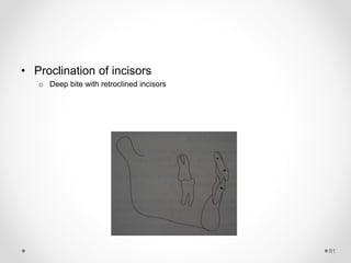 81
• Proclination of incisors
o Deep bite with retroclined incisors
 