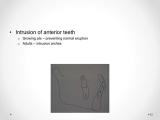 82
• Intrusion of anterior teeth
o Growing pts – preventing normal eruption
o Adults – intrusion arches
 