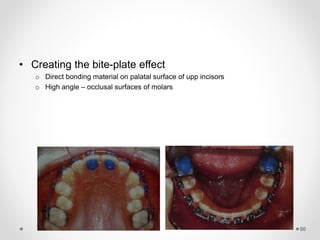 86
• Creating the bite-plate effect
o Direct bonding material on palatal surface of upp incisors
o High angle – occlusal surfaces of molars
 