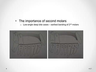 87
• The importance of second molars
o Low-angle deep bite cases – earliest banding of 2nd molars
 