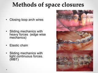Methods of space closures
• Closing loop arch wires
• Sliding mechanics with
heavy forces (edge wise
mechanics)
• Elastic chain
• Sliding mechanics with
light continuous forces.
(MBT)
 