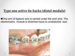Type one active tie backs (distal module)
One arm of ligature wire is carried under the arch wire. The
electrometric module is stretched twice to unstretched size.
 
