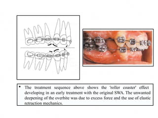 MBT -systemized orthodontic treatment mechanics.pptx