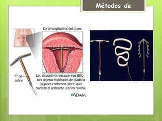 Métodos de
 Barreira
 