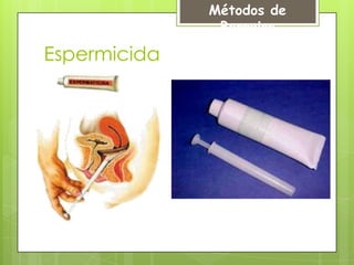 Métodos de
               Barreira

Espermicida
 