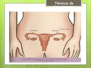 Técnicas de
Esterilização
 