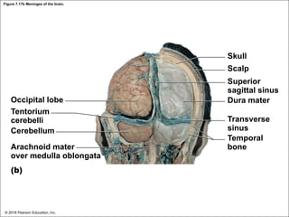 Figure 7.17b Meninges of the brain.
Skull
Scalp
Superior
sagittal sinus
Dura mater
Transverse
sinus
Temporal
bone
Occipital lobe
Tentorium
cerebelli
Cerebellum
Arachnoid mater
over medulla oblongata
(b)
© 2018 Pearson Education, Inc.
 