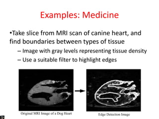 Examples: Medicine
•Take slice from MRI scan of canine heart, and
find boundaries between types of tissue
– Image with gray levels representing tissue density
– Use a suitable filter to highlight edges
Original MRI Image of a Dog Heart Edge Detection Image
 
