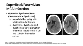 Opercular Infarction Mca & aca syndromes | PPTX