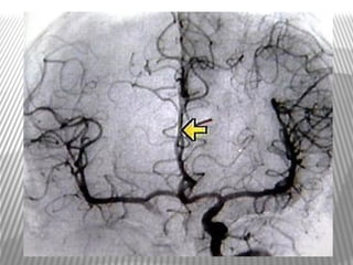 Mca anatomy 