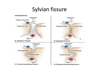 Sylvian fissure
 