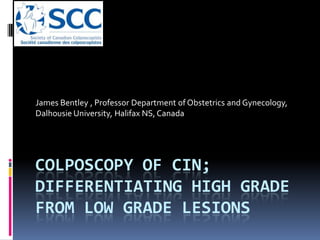 COLPOSCOPY OF CIN;
DIFFERENTIATING HIGH GRADE
FROM LOW GRADE LESIONS
James Bentley , Professor Department of Obstetrics and Gynecology,
Dalhousie University, Halifax NS, Canada
 