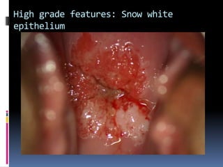 High grade features: Snow white
epithelium
 