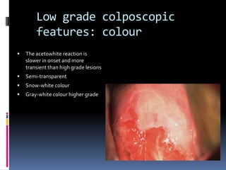 Low grade colposcopic
features: colour
 The acetowhite reaction is
slower in onset and more
transient than high grade lesions
 Semi-transparent
 Snow-white colour
 Gray-white colour higher grade
 