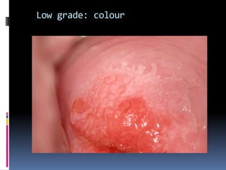 Low grade: colour
 