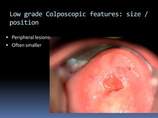Low grade Colposcopic features: size /
position
 Peripheral lesions
 Often smaller
 