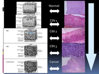 Normal
CIN 1
CIN 2
CIN 3
Cancer
 