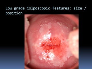 Low grade Colposcopic features: size /
position
 