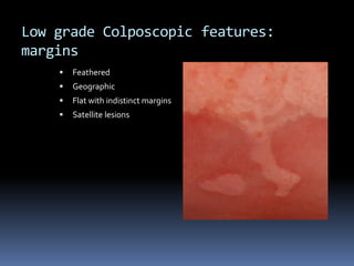 Low grade Colposcopic features:
margins
 Feathered
 Geographic
 Flat with indistinct margins
 Satellite lesions
 