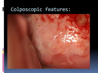 Colposcopic features:
margins
 