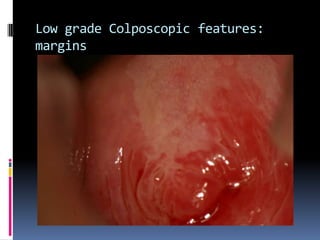 Low grade Colposcopic features:
margins
 