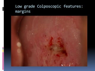 Low grade Colposcopic features:
margins
 