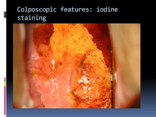 Colposcopic features: iodine
staining
 