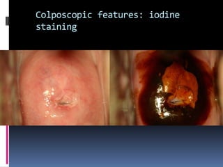 Colposcopic features: iodine
staining
 