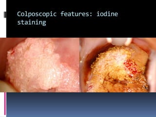 Colposcopic features: iodine
staining
 
