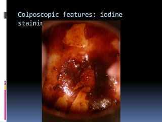 Colposcopic features: iodine
staining
 