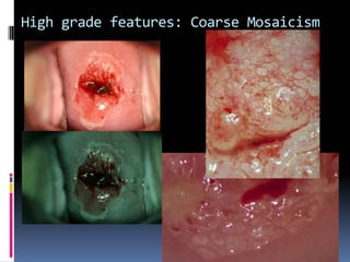 High grade features: Coarse Mosaicism
 