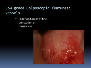 Low grade Colposcopic features:
vessels
 Ill defined areas of fine
punctation or
mosaicism
 