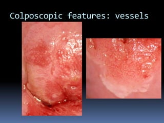 Colposcopic features: vessels
 