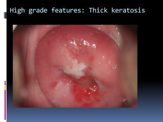 High grade features: Thick keratosis
 