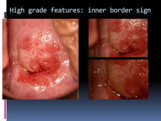 High grade features: inner border sign
 