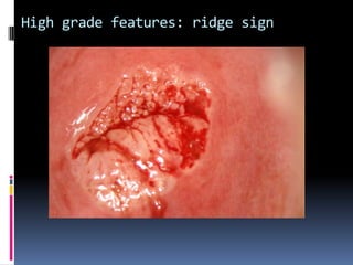 High grade features: ridge sign
 